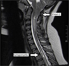 chiari_malformation.jpg