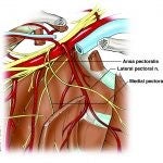 brachial_plexus_injury.jpg