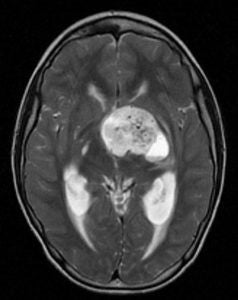 brain_tumors.jpg
